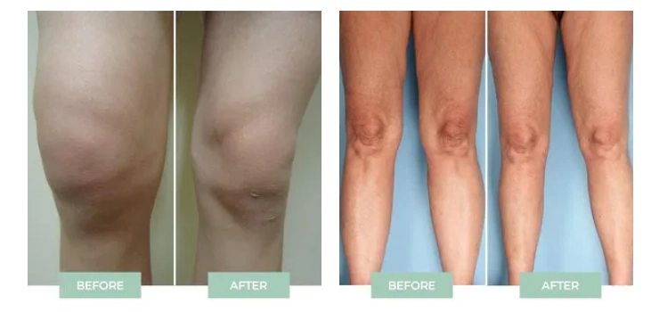 nooro before and after 2